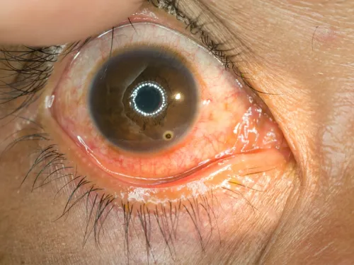 Metallischer Fremdkörper im Auge
