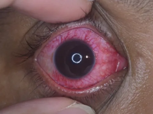 Chemische Verletzung am Auge